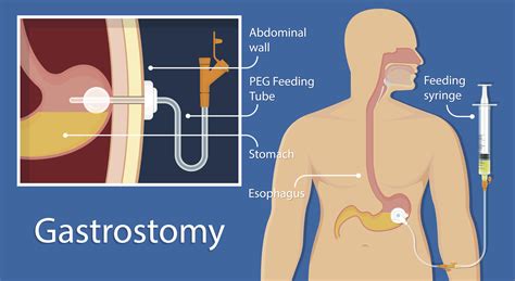 Information on Gastric Feeding Tube and Nasogastric Feeding Tube