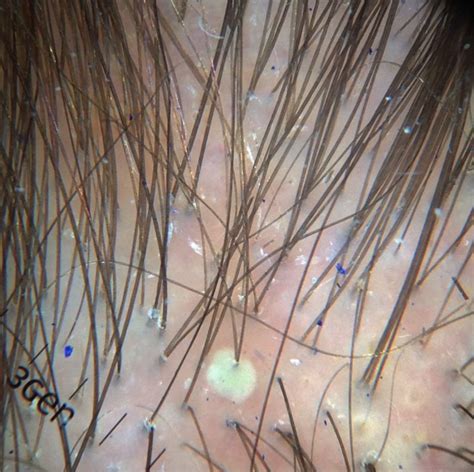 Scalp Folliculitis - not a single entity — Donovan Hair Clinic