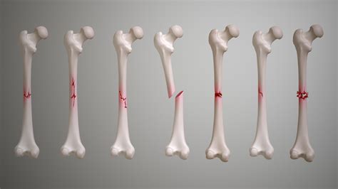 Fractures: Types, Symptoms, Causes and Treatment - Scientific Animations