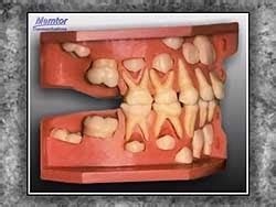 What is the sequence of teeth eruption? - IDW