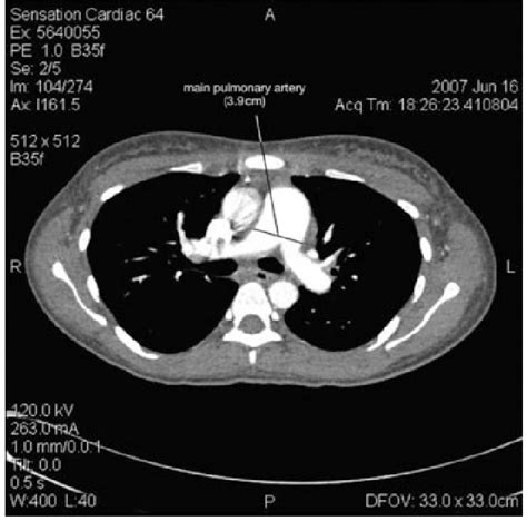 CT pulmonary angiogram showing enlargement of the main pulmonary artery ...