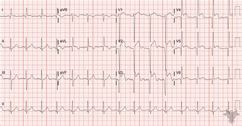 Left Ventricular Aneurysm | ECG Stampede