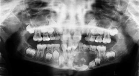 Case of the Week: Adenomatoid Odontogenic Tumor (AOT) – Dr. G's Toothpix