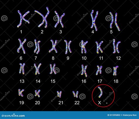 Turner S-syndrome Karyotype Stock Illustration - Illustration of gene ...