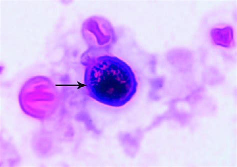 Cryptococcus On Gram Stain