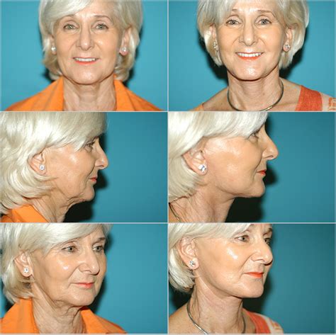 Before and After Plastic Surgery: Neck Lift | Naples Plastic Surgery