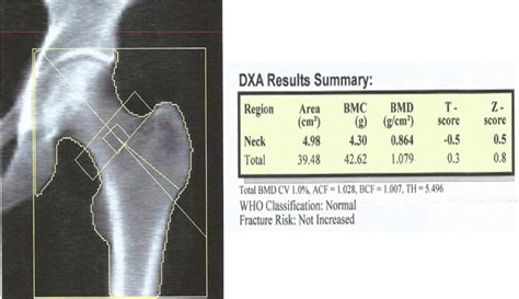 Understanding Your Bone Density Scan Results