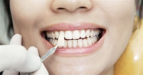 Porcelain Veneers — Procedure Costs & Recovery | by Webpolappusa | Medium