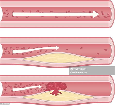 Atherosclerosis Diagram