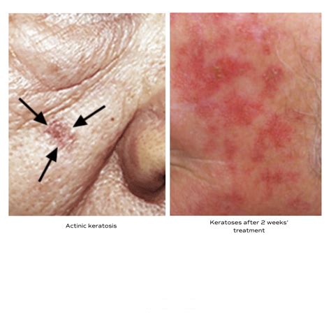 Treatment Options for Actinic Keratosis - Renew Dermatology ...