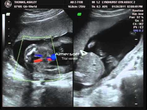 19 Week Ultrasound - Boy - YouTube