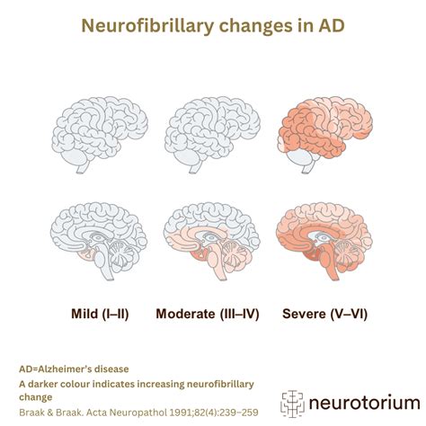 Neurofibrillary changes in Alzheimer's Disease - Neurotorium