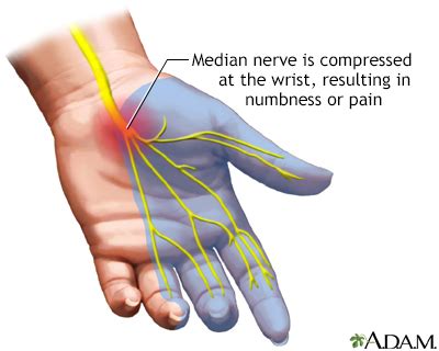 Carpal Tunnel Syndrome Symptoms, Doctors, Treatments, Advances & More ...