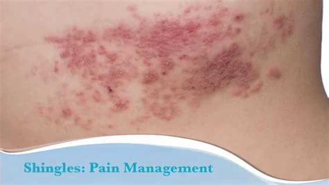 How to treat shingles - YouTube