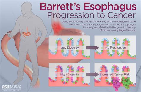 Jason Drees | Barrett’s Esophagus Infographic