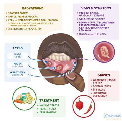 Aphthous Stomatitis: What Is It, Symptoms | Osmosis