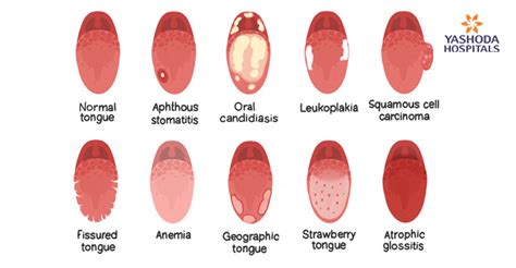 Signs Of Oral Cancer On Tongue