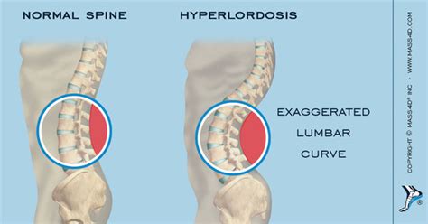 What is Lumbar Hyperlordosis? - MASS4D® Foot Orthotics