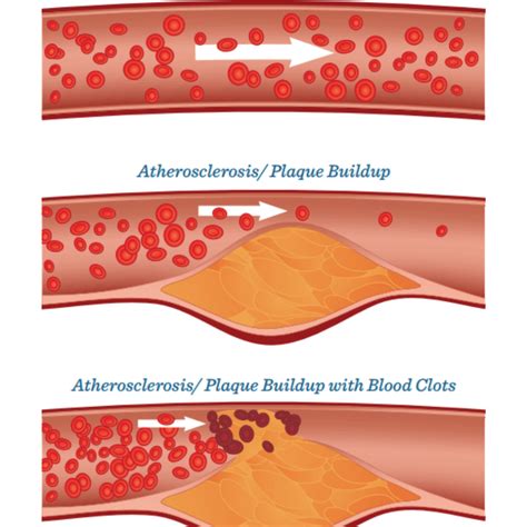 What Is Atherosclerosis: Prevention & Treatment | CardioVascular