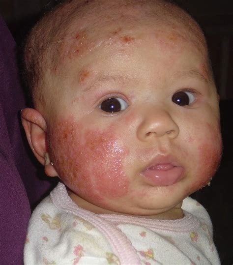 Allergies and neonatal acne baby - Acne Picture