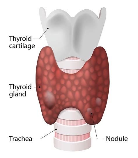 Thyroid Nodules and Thyroid Surgery Brisbane — Sunnybank Surgical Group ...