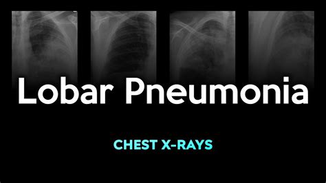 Left Lobar Pneumonia X Ray