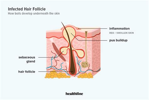 How To Avoid Heat Boils - Economicsprogress5