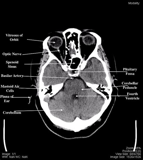 CT Scan Tips & Protocols: CT BRAIN ANATOMY