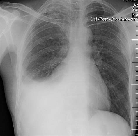 Pleural Effusion X Ray Lateral