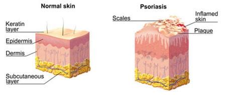 Scalp Psoriasis Treatment · 2021 Top Dermatology · Dermatologist NYC