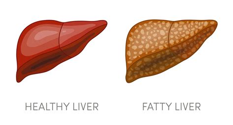 Planning Your Fatty Liver Diet Plan | Fatty Liver Guide