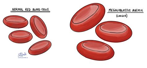 Anemia - Blood - MyPathologyReport.ca