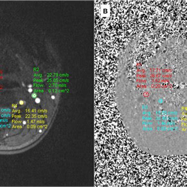 The magnitude and phase images of phase contrast MRI.: (A) The ...