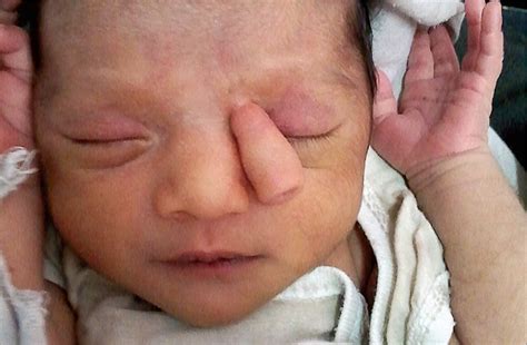 Trunklike Projection in 10-Day-Old Girl | Congenital Defects | JAMA ...