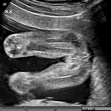 Does Ultrasound Look Like Baby - dbabyzi