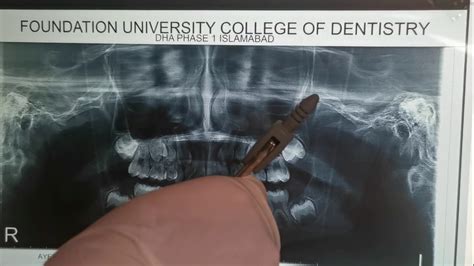 Radiographic method Mixed Dentition Analysis orthodontics - YouTube