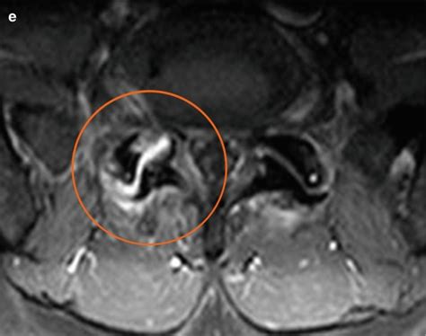 Facet Joint Arthropathy Mri