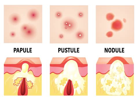 Cystic Acne — The Acne Lab