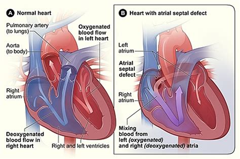 What is Congenital Heart Disease - Types, Causes, and Symptoms