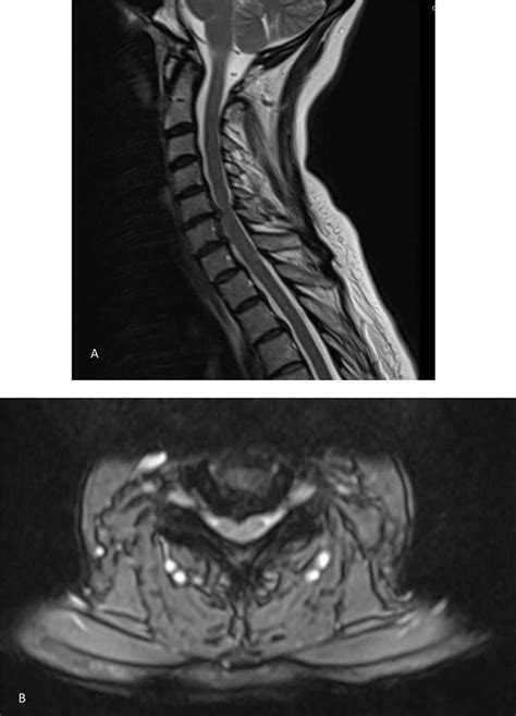 MRI showing bilateral C6 nerve root compression and left C7 nerve ...