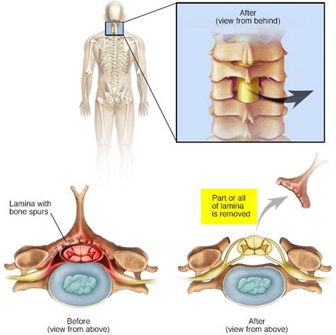 Laminectomy Surgery - Recovery & Laminectomy Complications