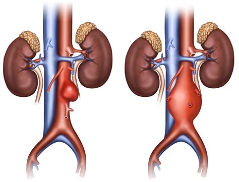 Abdominal Aortic Aneurysm: Endovascular vs. Surgical Repair » Scary ...