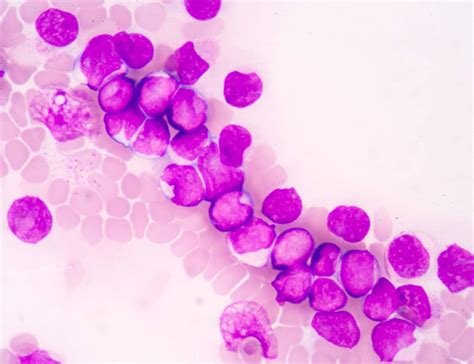 Acute Myeloid Leukemia: What Your Patients Need to Know - Hematology ...