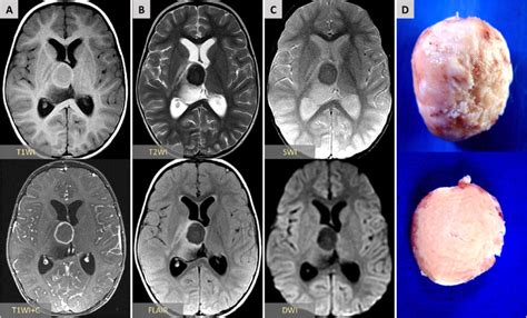 Axial brain MRI through the level of basal ganglia and thalami ...