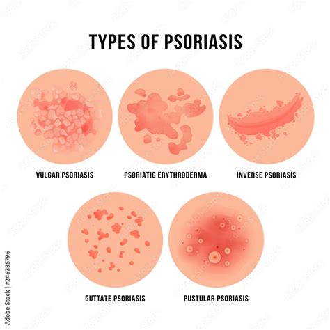 Skin Diseases Psoriasis