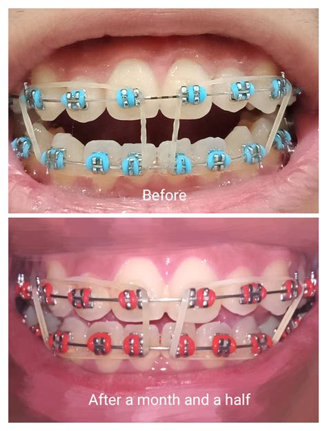 Elastics : braces