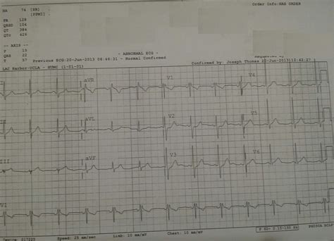 Posterior MI Recognition - emdocs