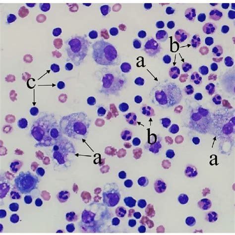 Microscopic image of histiocytes in pleural fluid (Wright-Giemsa stain ...