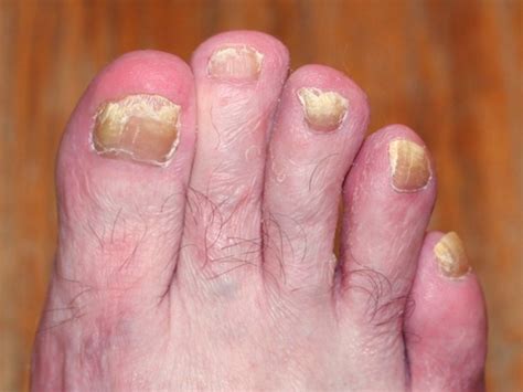 Toenail Fungus - Pictures, Symptoms, Causes, Treatment