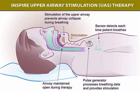 Sleep apnea implants for tongue to be tested | CBC News